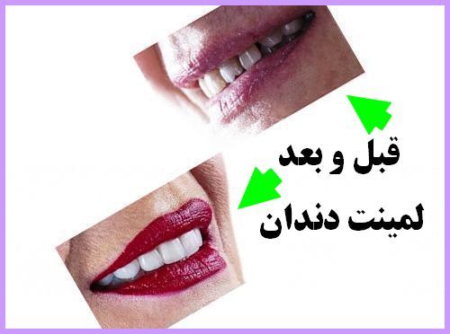 لمینت های دائمی یا موقت بزنیم 